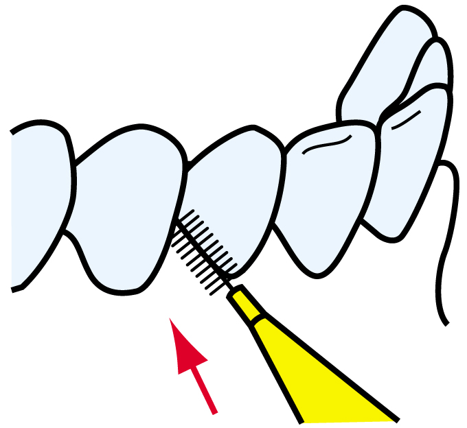 赤い矢印で示された歯のすき間に、黄色の歯間ブラシを差し込んで清掃しているイラスト