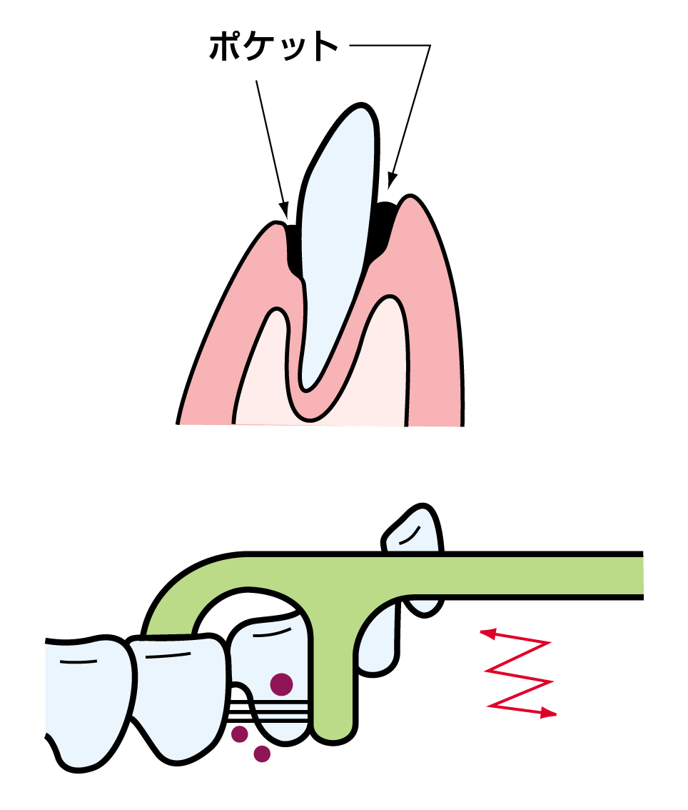 歯ぐきの「ポケット」と示された部分のイラストと、その下で歯の根元に糸ようじを当てているイラスト